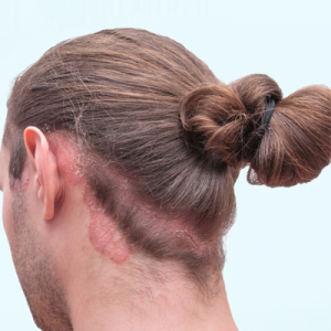 Symptoms of Psoriasis on scalp