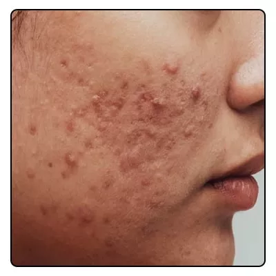 acne homeopathy treatment