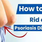 How To Get Rid of Psoriasis Disease?