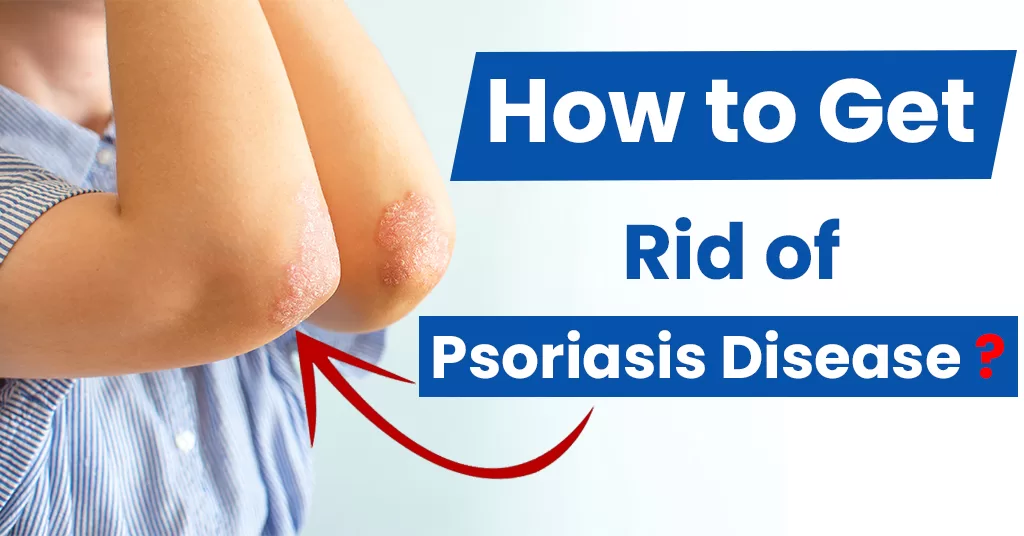 How To Get Rid of Psoriasis Disease?