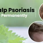 scalp psoriasis homeopathy treatment