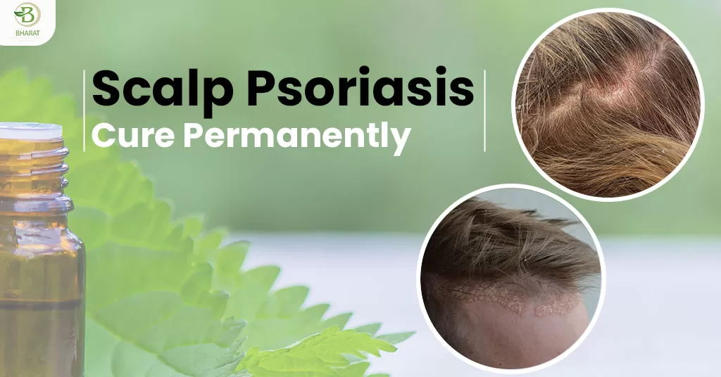 scalp psoriasis homeopathy treatment