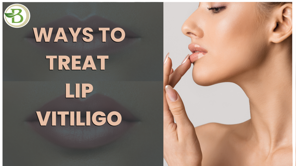 lip vitiligo homeopathic treatment