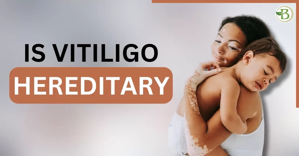 homeopathic medicine for vitiligo