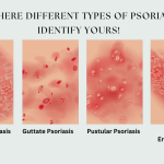 psoriasis treatment in homeopathy