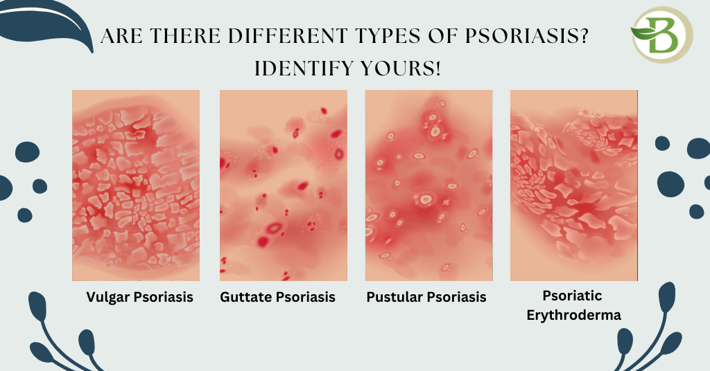 psoriasis treatment in homeopathy