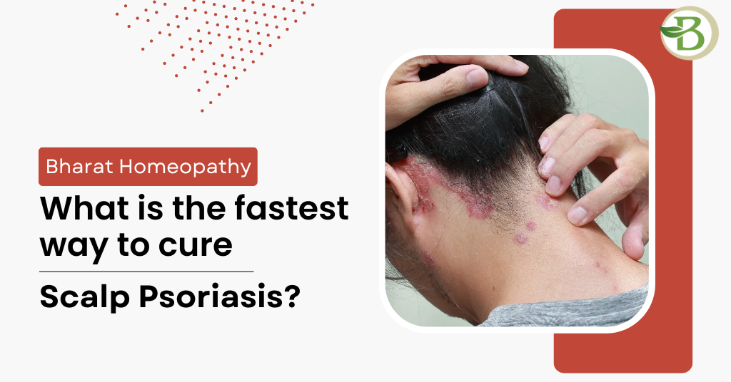 scalp psoriasis symptoms