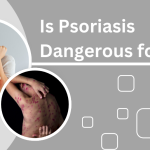 homeopathic treatment for psoriasis
