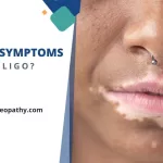 vitiligo on lips