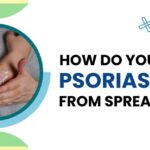 homeopathic treatment for psoriasis?