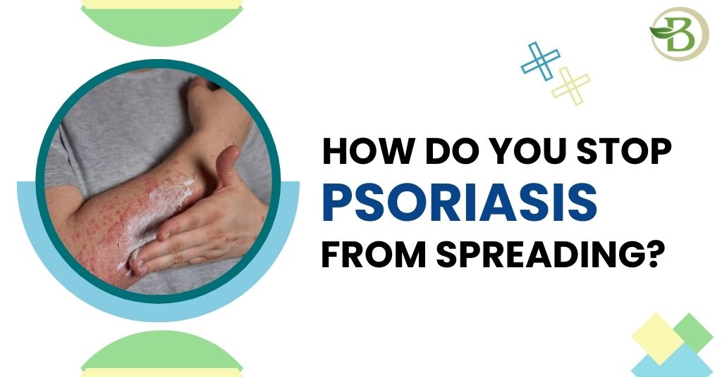 homeopathic treatment for psoriasis?