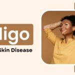 vitiligo a skin disease