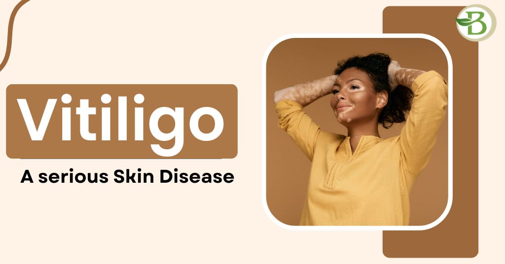 vitiligo a skin disease