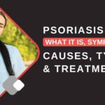 Psoriasis treatment