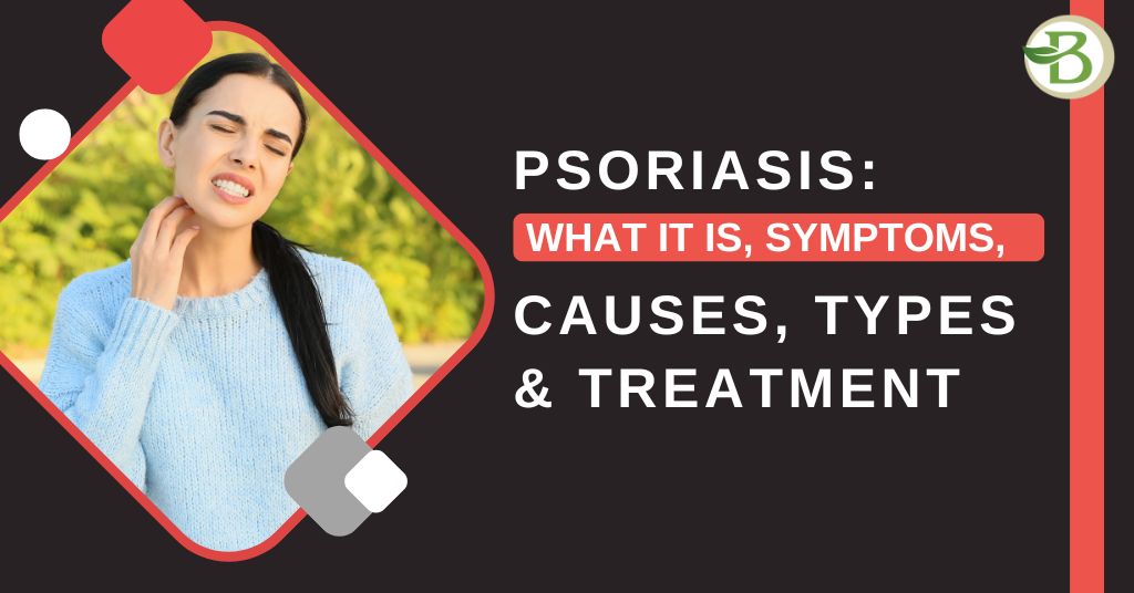 Psoriasis treatment