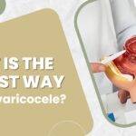 varicocele treatment