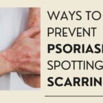 Ways to Prevent Psoriasis Spotting and Scarring