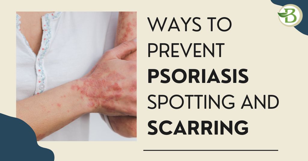 Ways to Prevent Psoriasis Spotting and Scarring