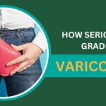 How serious is a Grade 3 varicocele?