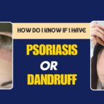 homeopathic medicine for psoriasis