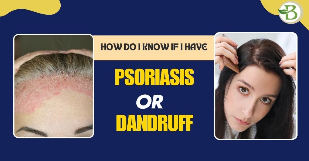 homeopathic medicine for psoriasis