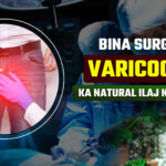 Bina Surgery Varicocele Ka Natural Ilaj Kaise Kare