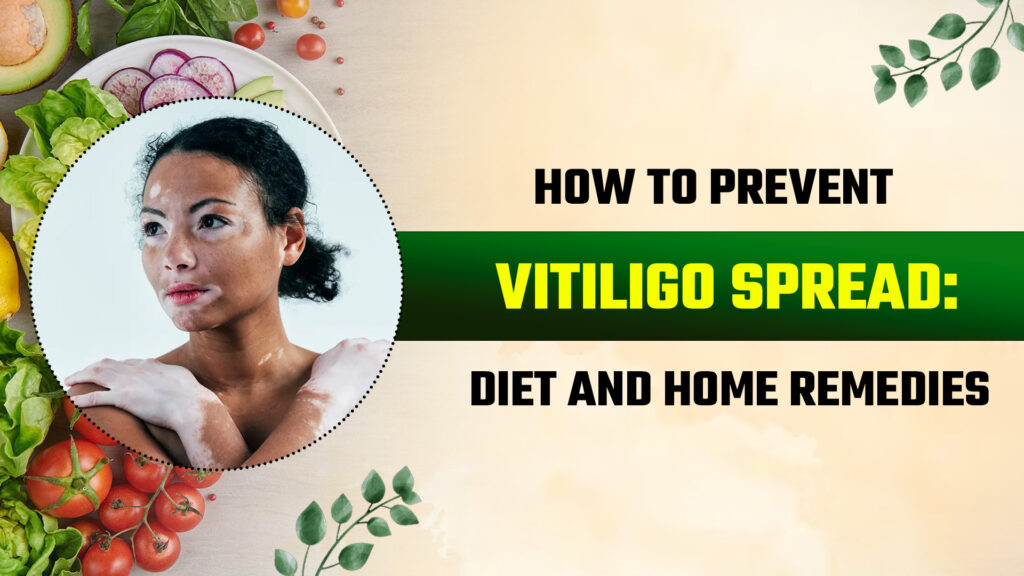 How to Prevent Vitiligo Spread: Diet and Home Remedies