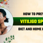 How to Prevent Vitiligo Spread: Diet and Home Remedies