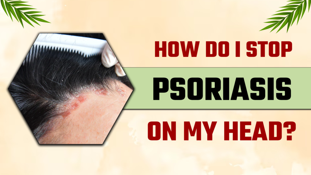 scalp psoriasis