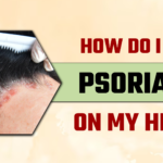 scalp psoriasis