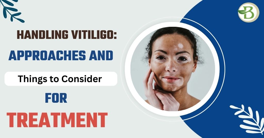 Handling Vitiligo: Approaches and Things to Consider for Treatment