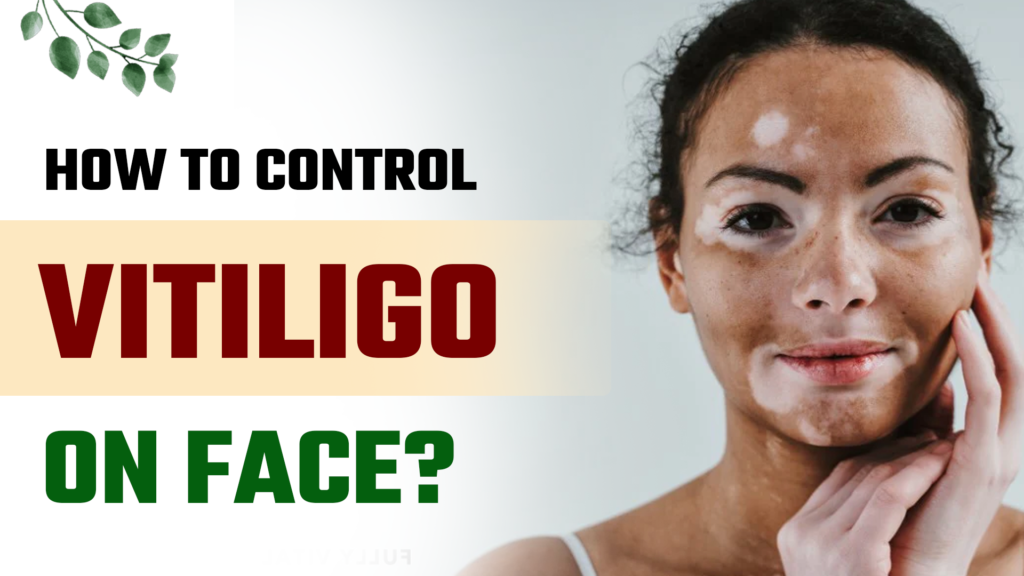 Vitiligo