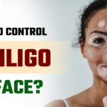 Vitiligo