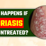 What happens if psoriasis goes untreated?