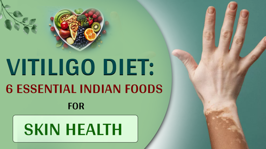 Vitiligo diet