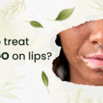 How to treat vitiligo on lips?