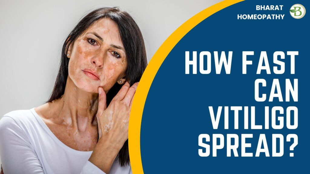 How fast can vitiligo spread?