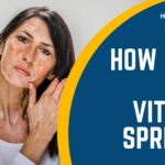 How fast can vitiligo spread?