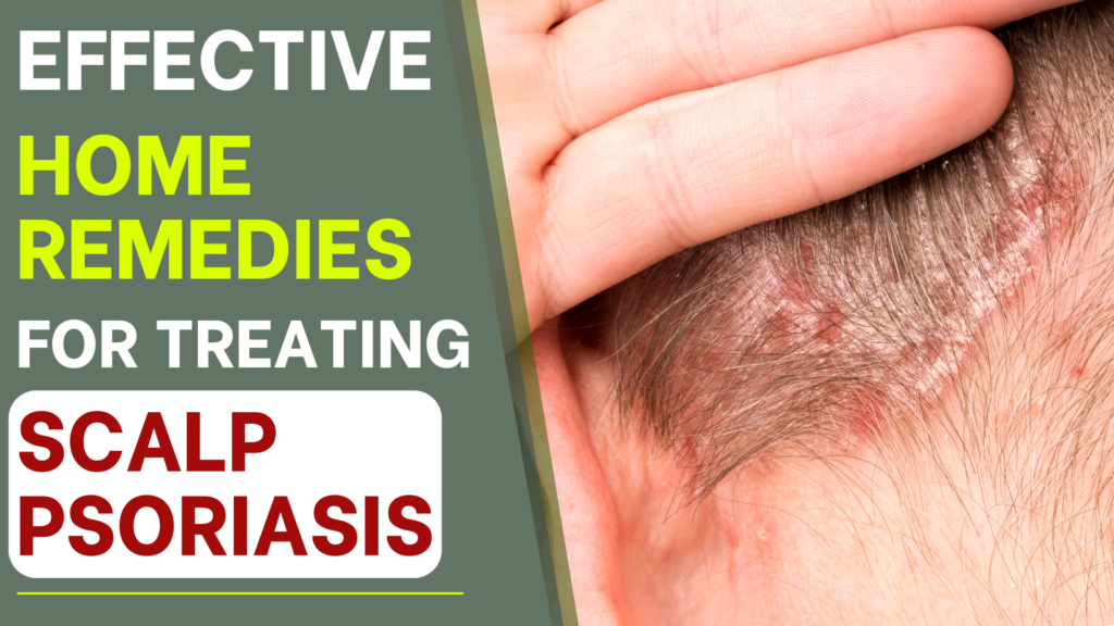 Effective Home Remedies for Treating Scalp Psoriasis 