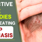 Effective Home Remedies for Treating Scalp Psoriasis 