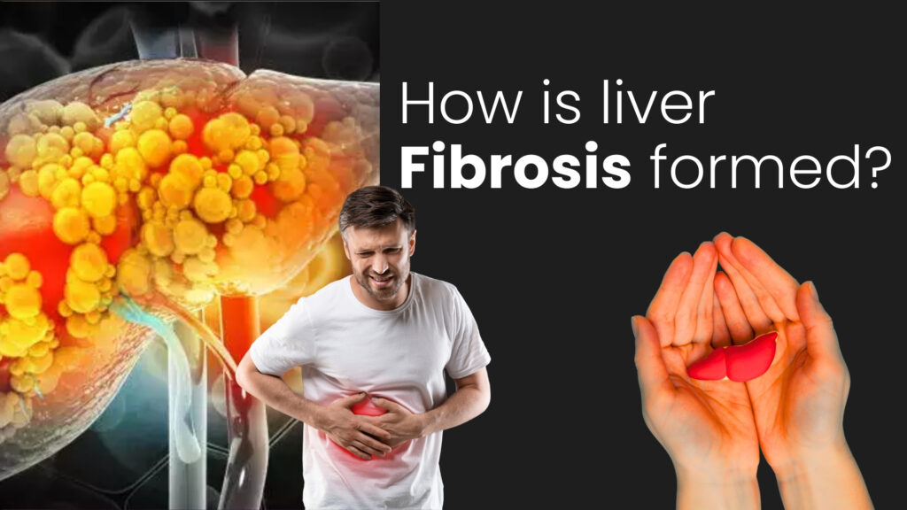 How is liver fibrosis formed?