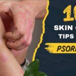 10-skin-care tips for psoriasis