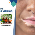 vitiligo