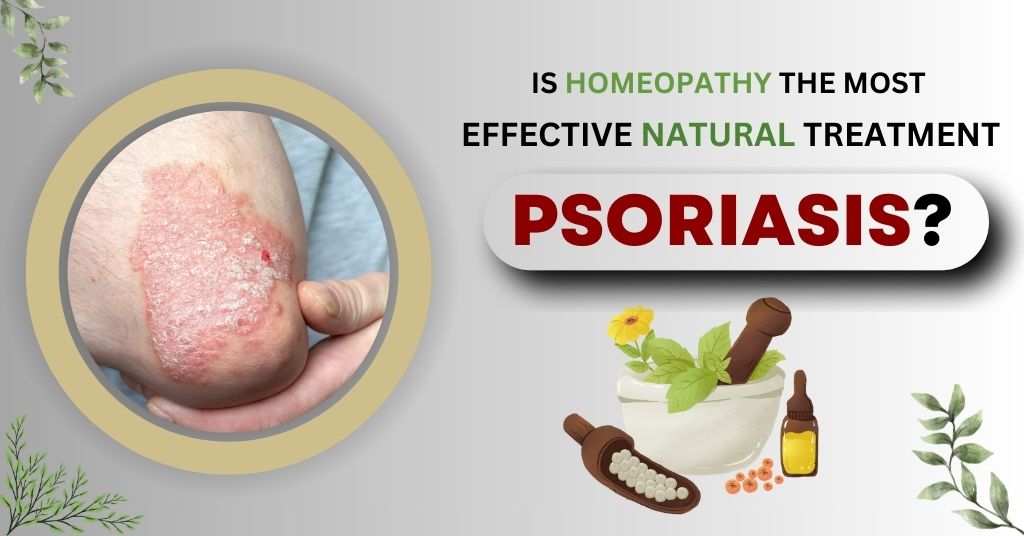 Is homeopathy the most effective natural treatment for psoriasis?