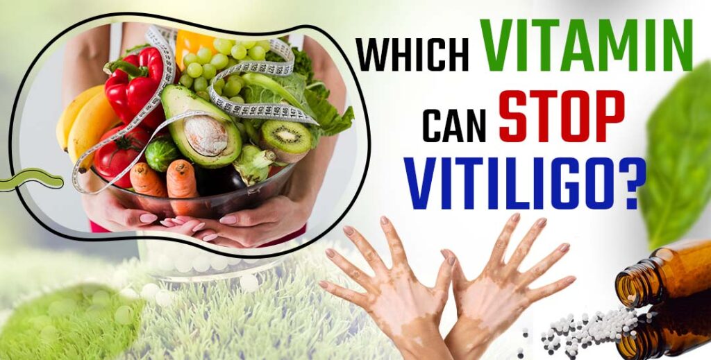 Which vitamin can stop vitiligo?