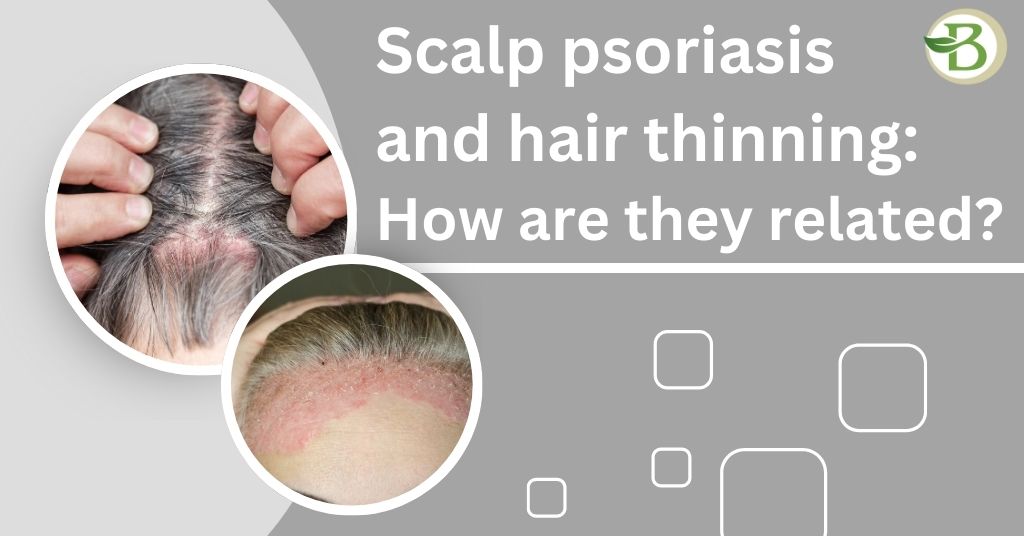 Scalp psoriasis and hair thinning: How are they related?