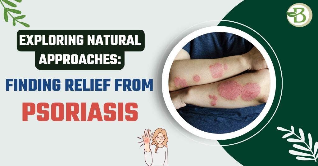Exploring Natural Approaches: Finding Relief from Psoriasis