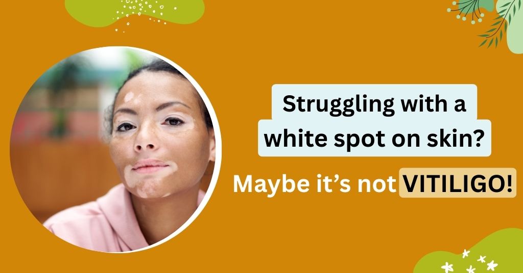 Struggling with a white spot on skin? Maybe it’s not VITILIGO!
