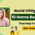 World Vitiligo Day: 10 Home Remedies That Help Treat The Skin At Home