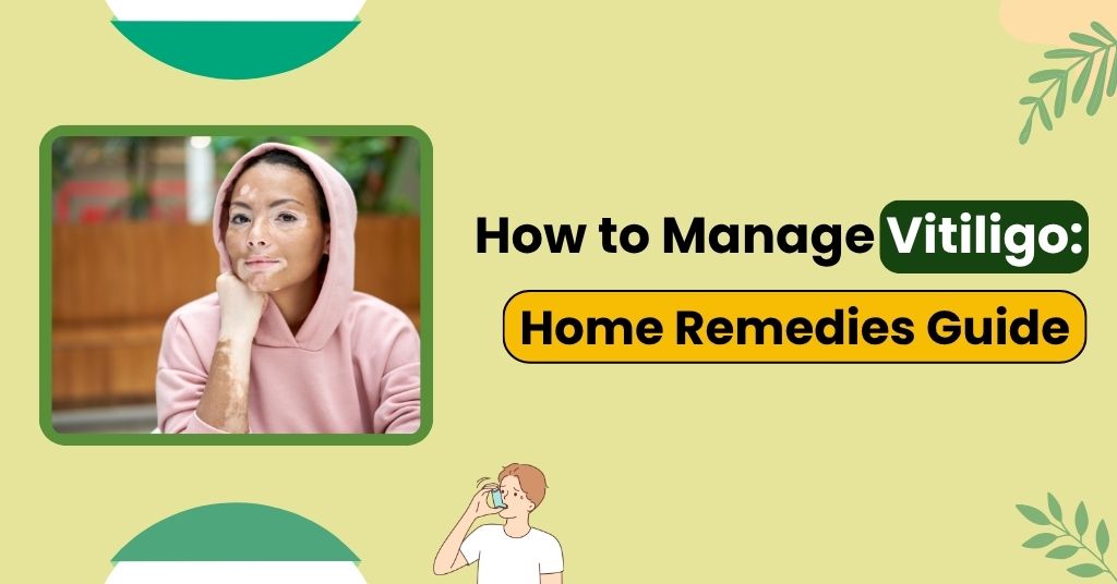 How to Manage Vitiligo: Home Remedies Guide